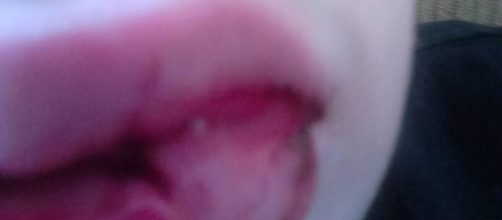 Le labbra tumefatte del piccolo Lorenzo