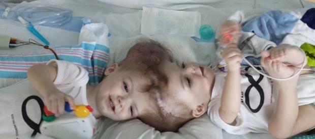 Jadon e Anias McDonald, de 13 meses, são separados após longas horas de cirurgia Jadon e Anias McDonald, de 13 meses, são separados após longas horas de cirurgia
