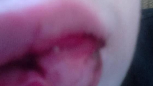 Le labbra tumefatte del piccolo Lorenzo