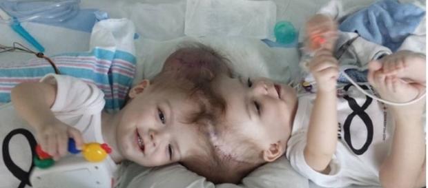 Os gêmeos foram separados através de cirurgia. Os gêmeos foram separados através de cirurgia.