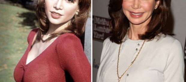 Rachel Zoe Plastic Surgery Before and After Photo | CELEBS ... - pinterest.com Rachel Zoe Plastic Surgery Before and After Photo | CELEBS ... - pinterest.com