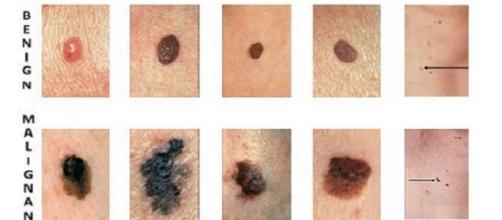 Seguendo le indicazioni suggerite dalla sigla ABCDE si può identificare un melanoma in una fase precoce.