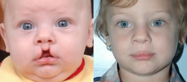 Fissura Labiopalatina bilateral - Antes e depois da cirurgia de reparação Fissura Labiopalatina bilateral - Antes e depois da cirurgia de reparação
