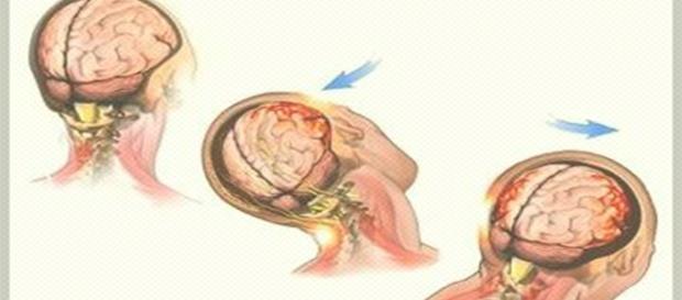 Simulação de como acontece uma concussão cerebral Simulação de como acontece uma concussão cerebral