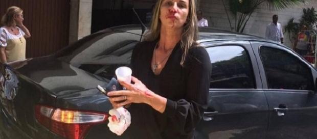 Além do nariz, Luciana teve o dedo quebrado Além do nariz, Luciana teve o dedo quebrado