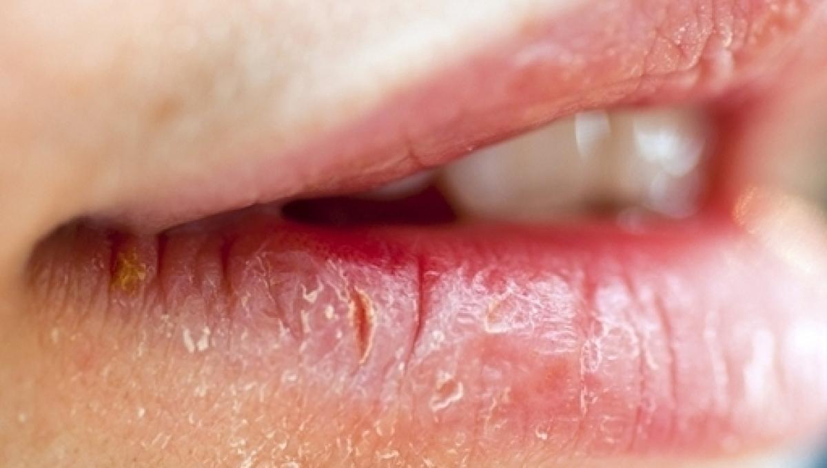 Lábios ressecados podem causar sérias doenças