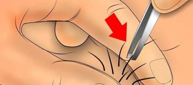 Ilustração de retirada de um pelo encravado com uso de pinça Ilustração de retirada de um pelo encravado com uso de pinça