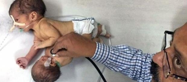 Caso raro surgiu na Índia com o nascimento de um gémeo parasita. Caso raro surgiu na Índia com o nascimento de um gémeo parasita.