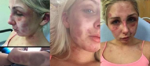 Jovem de 18 anos ficou cheia de hematomas. Jovem de 18 anos ficou cheia de hematomas.