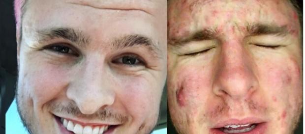 Antes e depois - resultados de dicas contra o acne. Antes e depois - resultados de dicas contra o acne.