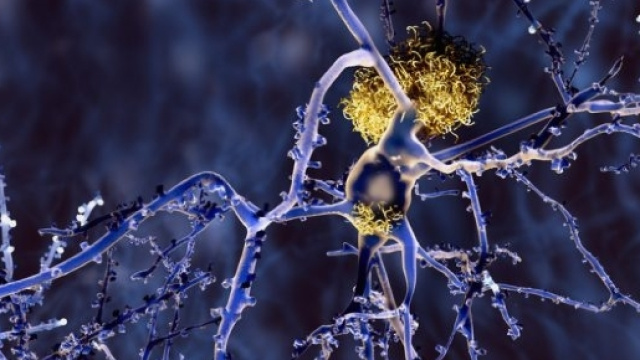 Raffigurazione grafica di placche amiloidi - in giallo - che soffocano un neurone.