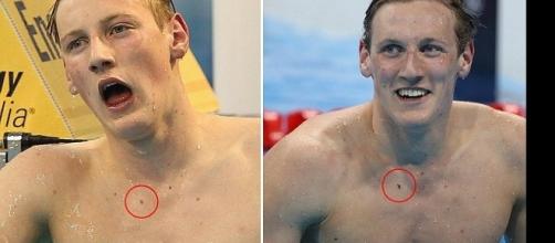 Imagens de nadador diagnosticado com câncer de pele.