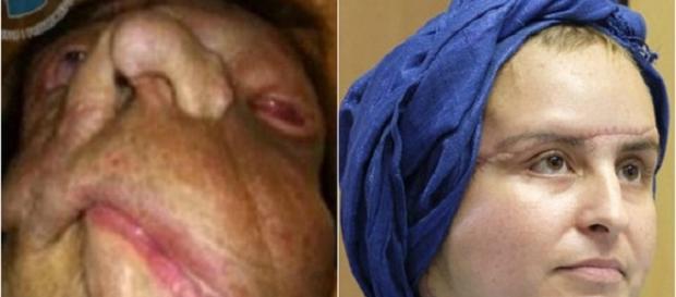 Joanna tinha uma doença chamada neurofibromatose Joanna tinha uma doença chamada neurofibromatose