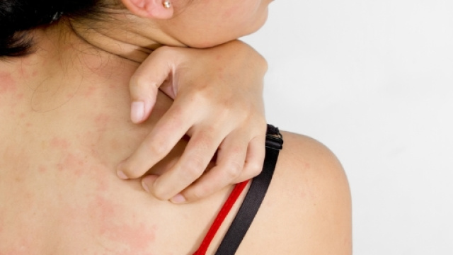 Psoriasi: 6 miti su questa malattia poco conosciuta
