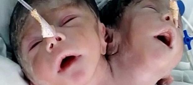 Bebê nasceu com 2 cabeças e morreu 32 horas depois Bebê nasceu com 2 cabeças e morreu 32 horas depois