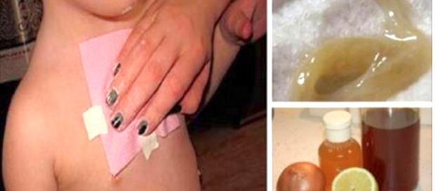 Receita promete eliminar a tosse e o catarro Receita promete eliminar a tosse e o catarro