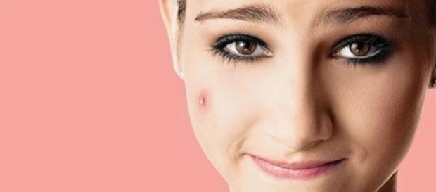 Se você tem o hábito de apertar espinhas, tome cuidado Se você tem o hábito de apertar espinhas, tome cuidado