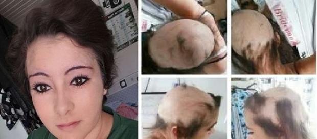 A alopecia faz a pessoa perder os cabelos de repente (Foto: Catraca Livre) A alopecia faz a pessoa perder os cabelos de repente (Foto: Catraca Livre)