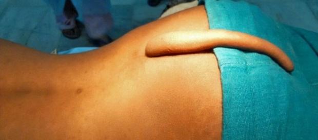 Imagem de cauda encontrada em corpo de paciente. Imagem de cauda encontrada em corpo de paciente.