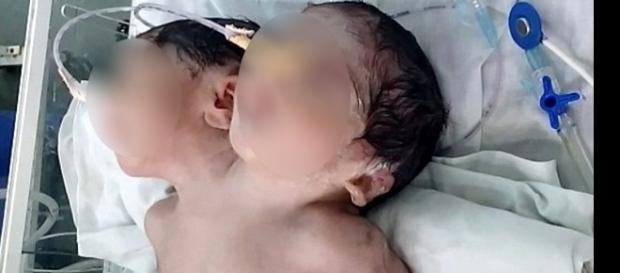 Bebê que nasceu com duas cabeças na Índia Bebê que nasceu com duas cabeças na Índia