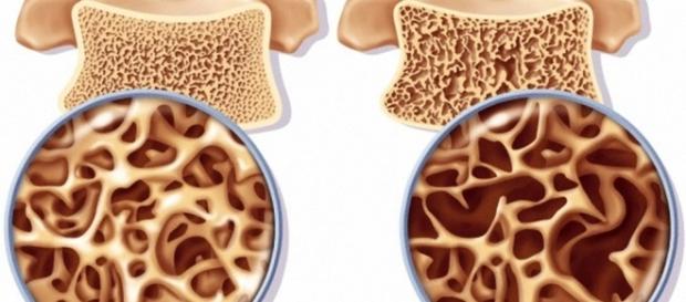 Dia Mundial da Osteoporose: doença também atinge os homens Dia Mundial da Osteoporose: doença também atinge os homens