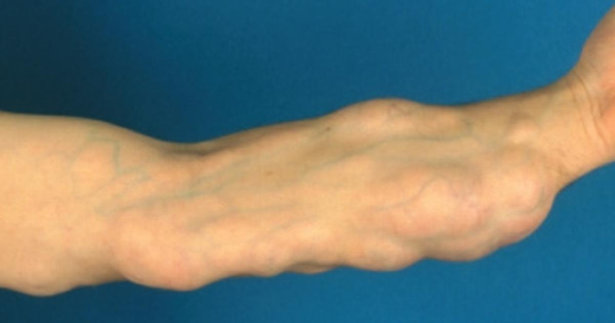 Assustador Médica remove lipoma do tamanho de um melão do braço de uma