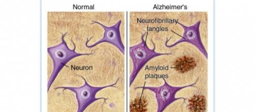 Segni tipici dell'Alzheimer: le placche amiloidi (Amyloid plaques) e gli agglomerati di proteina tau (Neurofibrillary tangles)
