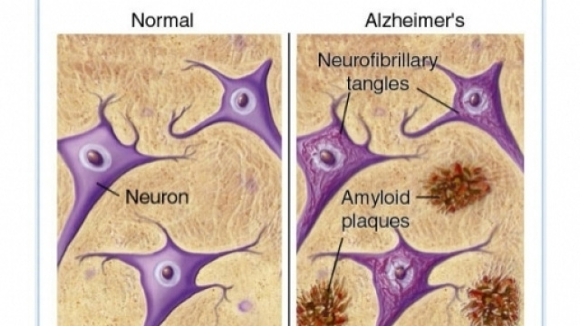 Segni tipici dell'Alzheimer: le placche amiloidi (Amyloid plaques) e gli agglomerati di proteina tau (Neurofibrillary tangles)