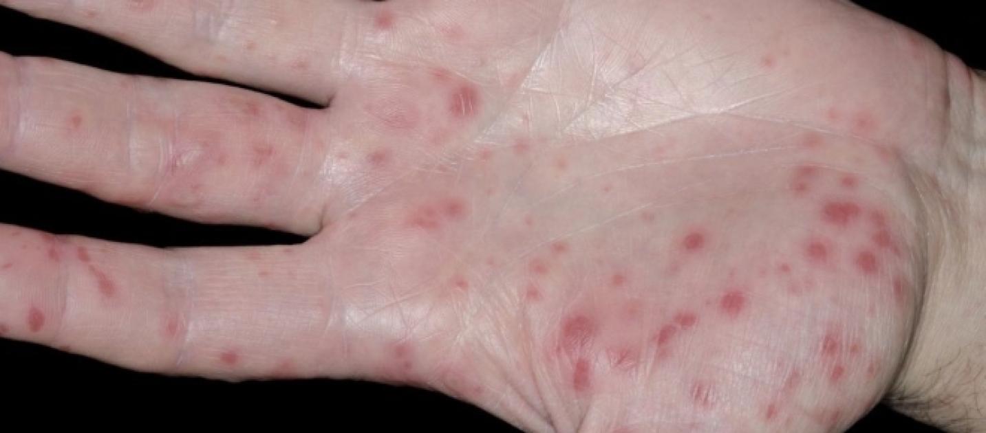 Hand Foot And Mouth Disease Lesions
