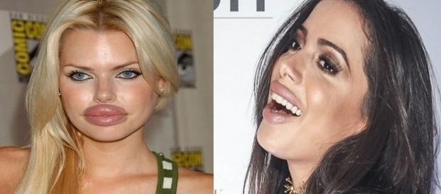 Preenchimentos de botox que não deram muito certo Preenchimentos de botox que não deram muito certo