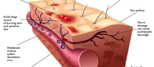 Varicella 'cattiva': importante vaccinarsi