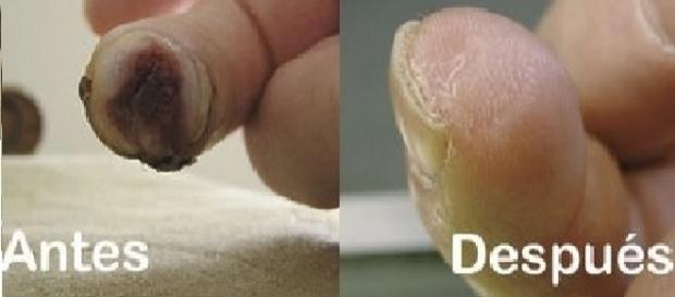Dedo de Lee Spievack antes y despues del proceso Dedo de Lee Spievack antes y despues del proceso
