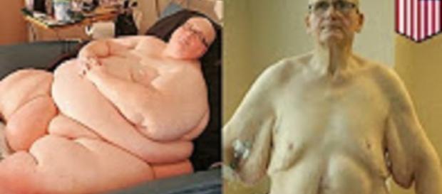 Source: TomoNews US Youtube "World's fattest man slims down: the obesity, weight loss and body issues compilation" Source: TomoNews US Youtube "World's fattest man slims down: the obesity, weight loss and body issues compilation"