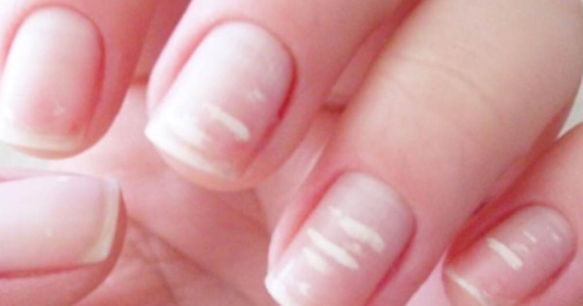 Você tem essas manchas brancas nas unhas Veja o que elas significam