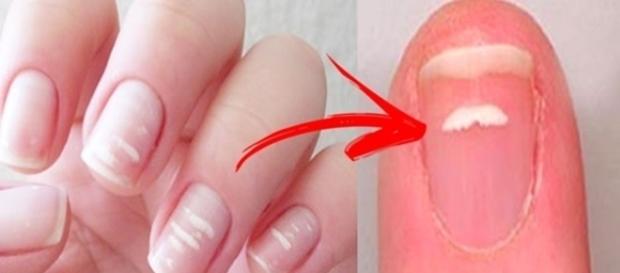 Sinal de alguma doença séria? Descubra tudo sobre as manchas brancas nas unhas Sinal de alguma doença séria? Descubra tudo sobre as manchas brancas nas unhas