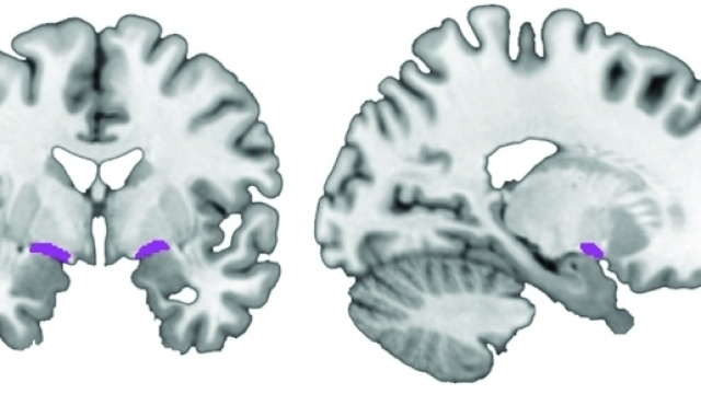Un'immagine dello studio con il basal forebrain, area da cui prenderebbe origine l'Alzheimer, indicato in viola