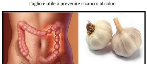Tra le molteplici virtù dell'aglio c'è anche una documentata attività preventiva del tumore al colon.