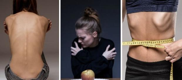 Cómo afecta a las mujeres el fantasma de la anorexia? - telemetro.com Cómo afecta a las mujeres el fantasma de la anorexia? - telemetro.com