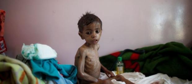 UN Agency: Child Malnutrition at 'All-time High' in Yemen - voanews.com UN Agency: Child Malnutrition at 'All-time High' in Yemen - voanews.com