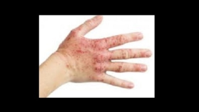 Il nuovo farmaco contro l'eczema, il crisaborole, &egrave; un inibitore della PDE4, ed un antagonista di due interleuchine (Il-12 e IL-23) e del TNF-alfa.