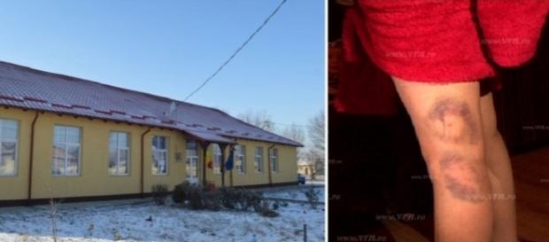 Școala din Todirești și picioarele profesoarei după agresiune Școala din Todirești și picioarele profesoarei după agresiune