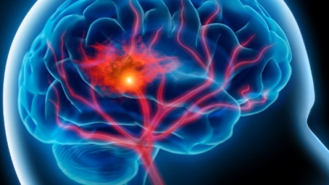 AVC du jeune adulte : Découverte d'un gène permettant de prévenir ... - mehach-magazine.com