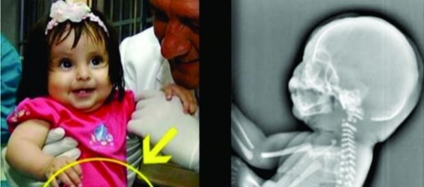 Aos 6 meses de gravidez, a mulher descobriu que estava crescendo uma cauda em seu bebê Aos 6 meses de gravidez, a mulher descobriu que estava crescendo uma cauda em seu bebê
