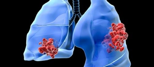 Approvati nuovi anticorpi monoclonali anti-PD-L1, efficcaci anche nel cancro al polmone non-a-piccole-cellule (NSCLC).