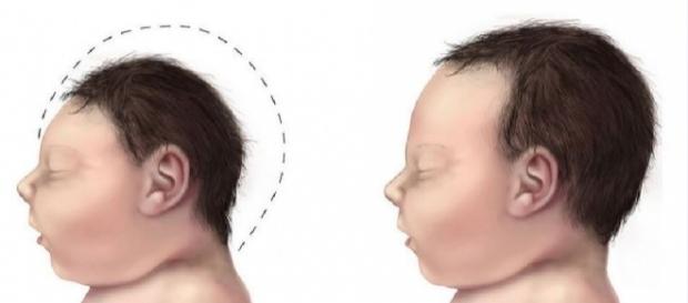 Babies microcephaly comparison, Wikipedia Babies microcephaly comparison, Wikipedia