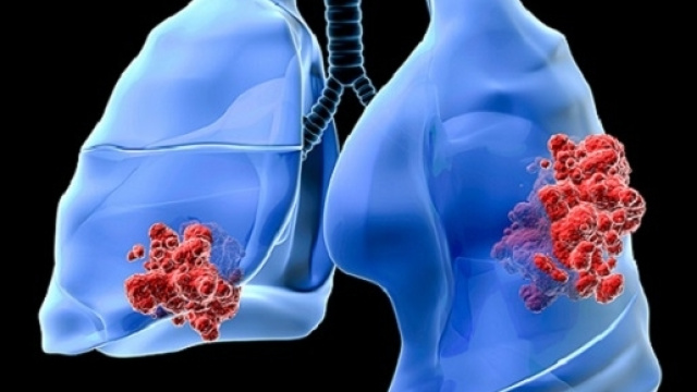 Approvati nuovi anticorpi monoclonali anti-PD-L1, efficcaci anche nel cancro al polmone non-a-piccole-cellule (NSCLC).