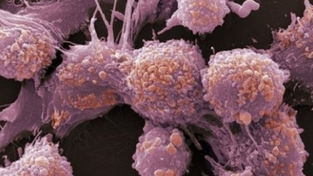 Combinando l’azione di una sostanza fotosensibile con un raggio laser di luce rossa, si può distruggere, in sicurezza, il tumore alla prostata.