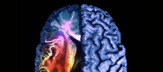 I danni da ictus potrebbero essere limitati dal peptide C3a. I danni da ictus potrebbero essere limitati dal peptide C3a.