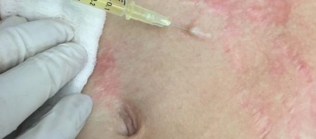 Plasma rico en plaquetas para tratar lesiones en la piel Plasma rico en plaquetas para tratar lesiones en la piel