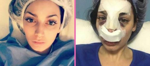 Secret Story : Nadège Lacroix s'est fait refaire le nez ! Secret Story : Nadège Lacroix s'est fait refaire le nez !